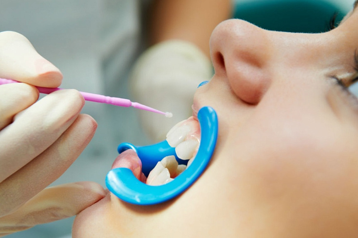 Фторирование зубов у детей. Стоматология "Евродент" в Черкесске