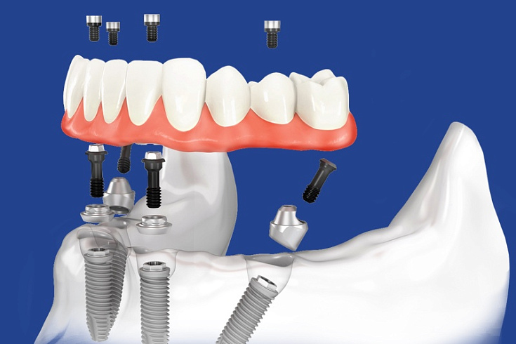 Имплантация All-on-4. Стоматология "Евродент" в Черкесске